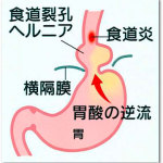 食道裂孔ヘルニアは逆流性食道炎を引き起こす！腹圧を上げるところから始めよう